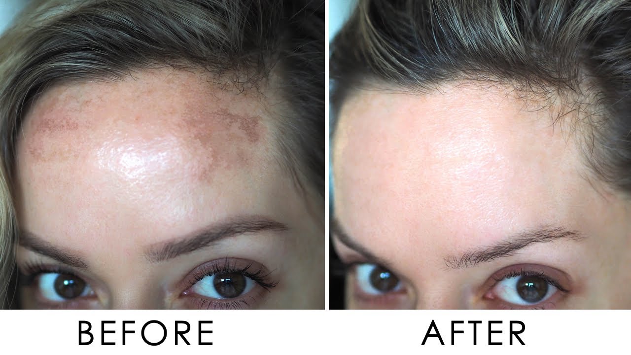 pigmentation Treatment dubai